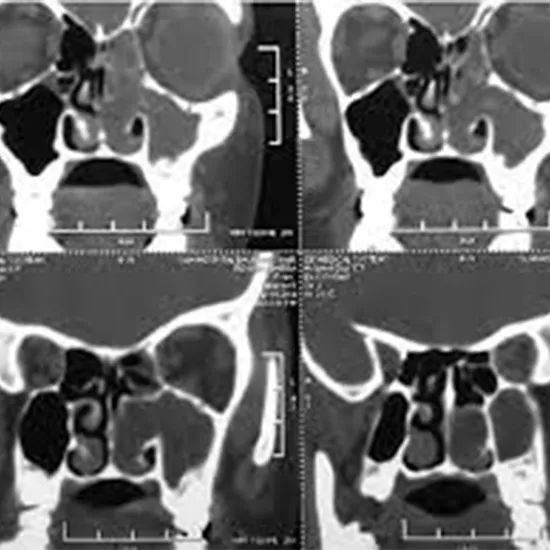 CT (Computed tomography) Sinus or Nose Test